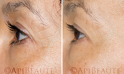 Cosmetics with Bee Venom trial, before and after